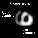 Right and Left Ventricles