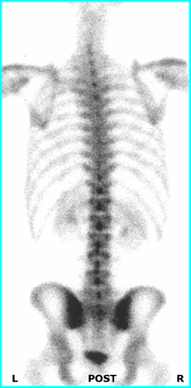 Bone Scan - POST Spine