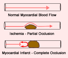 Blood Flow Compared:  Normal vs. ischemic vs. infarct