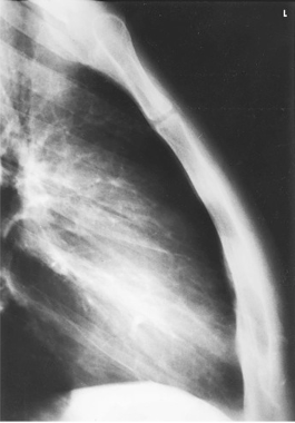 Sternum Radiographic Anatomy And Procedural Review