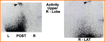 Pulmonary Aspiration Right Lobe