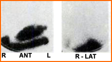 Normal - No activity is seen in the Lungs