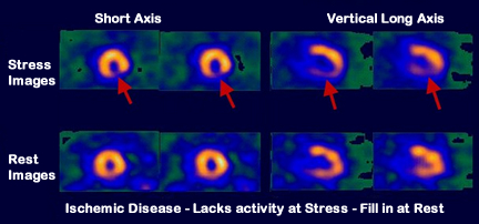 Ischemic Disease