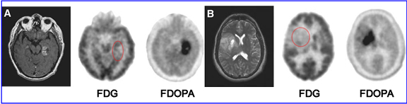 FDOPA vs. FDG in detected Low and High Grade Gliomas
